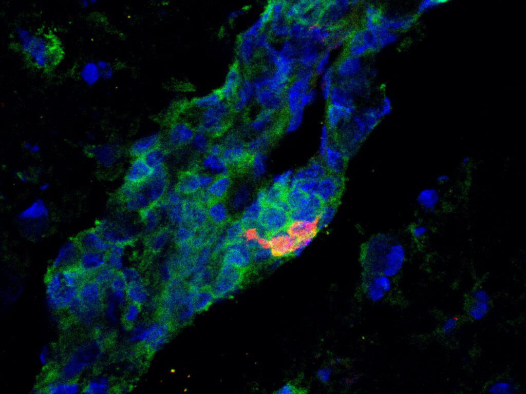 Das entzündete Hirngewebe eines Patienten mit Multipler Sklerose weist IgA-produzierende B-Zellen (rot) auf, die mittels Fluoreszenzmikroskopie sichtbar gemacht wurden. Grün zeigt CD19 als Marker für B-Zellen an, Blau die Zellkerne.