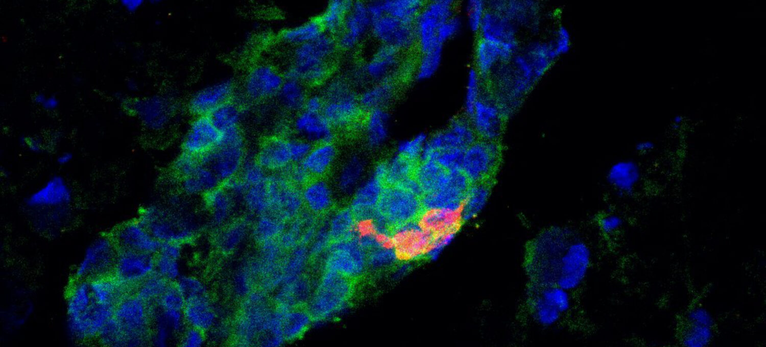 Das entzündete Hirngewebe eines Patienten mit Multipler Sklerose weist IgA-produzierende B-Zellen (rot) auf, die mittels Fluoreszenzmikroskopie sichtbar gemacht wurden. Grün zeigt CD19 als Marker für B-Zellen an, Blau die Zellkerne.